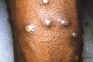 Ευλογιά των πιθήκων: Πότε μεταδίδεται πιο εύκολα  - Ποιοι θα εμβολιαστούν πρώτοι αν χρειαστεί