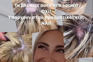 Δήμητρα Αλεξανδράκη: Έδειξε τι έπαθε το πρόσωπό της επειδή δεν έβαζε αντηλιακό [Βίντεο]
