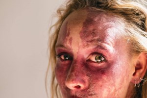 Σοκ: Ζυγίζει λιγότερο από 20 κιλά και κινδυνεύει να πεθάνει 36χρονη Βρετανίδα από σοβαρό λάθος των γιατρών - εικόνα 3