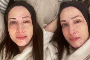 Κατερίνα Πλουμιδάκη: Τα χείλη της νέκρωσαν και σάπισαν από αποτυχημένη επέμβαση Ελληνα πλαστικού χειρουργού [Βίντεο]