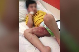 Θαλάσσια ανεμώνη: "Καμπανάκι" από τους ειδικούς - Τι πρέπει να προσέξουμε, τι να κάνουμε αν μας τσιμπήσει [Βίντεο] - εικόνα 2