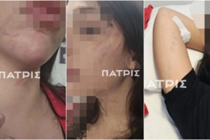 Έδεσσα: Συγκλονίζει η 29χρονη που ξυλοκοπήθηκε από τον σύντροφό της - "Τράβηξε βίντεο για να δείξει τι θα παθαίνω όταν δεν τον ακούω" - εικόνα 4