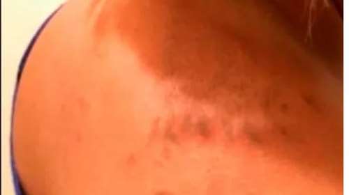 &quot;Δεν μπορείς να περιγράψεις τον πόνο,  λες και μου έριξαν βιτριόλι&quot;, λέει  γυναίκα που τσιμπήθηκε από μωβ μέδουσα