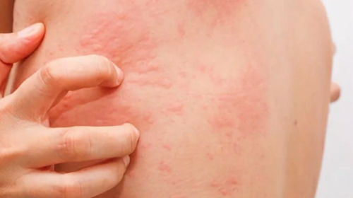 Νορβηγική ψώρα: Τα συμπτώματα και πώς μεταδίδεται - Τι πρέπει να ξέρετε