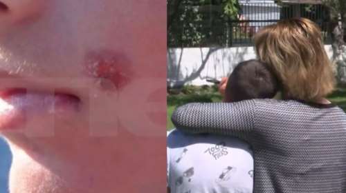 Bullying στην Πέλλα: &quot;Παλιοαλβανέ γύρνα στην πατρίδα σου&quot;- Ένα χρόνο βασανίζουν το παιδί που του έσβησαν τσιγάρο στο μάγουλο