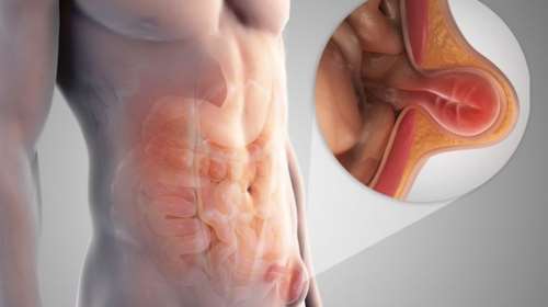 Βουβωνοκήλη: Πότε πρέπει να αντιμετωπίζεται και τι πρέπει να γνωρίζουμε για το χειρουργείο