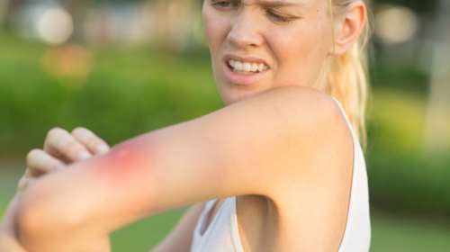 Πρώτες βοήθειες για τσίμπημα εντόμου, τσούχτρας ή δάγκωμα φιδιού: Τι να κάνετε