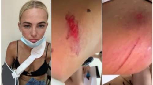 Κέρκυρα: &quot;Νόμιζα ότι θα πέθαινα&quot; – Βρετανίδα περιγράφει τις τρομακτικές στιγμές μετά το τροχαίο με γουρούνα [βίντεο]