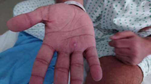 Ευλογιά των πιθήκων: 80 τα επιβεβαιωμένα κρούσματα στην Ελλάδα - Η κατάσταση στην Ευρώπη