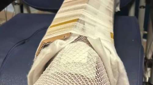 Εγινε και αυτό: Δεν είχαν γύψο και έδεσαν το πόδι 30χρονου σε χάρτινο κουτί σε νοσοκομείο στη Σικελία