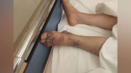 Αττική: Καταγγελία για κακοποίηση σε ιδιωτικό οίκο ευγηρίας - &quot;Μελανιασμένη, με σπασμένα πλευρά και χωρίς οξυγόνο&quot;