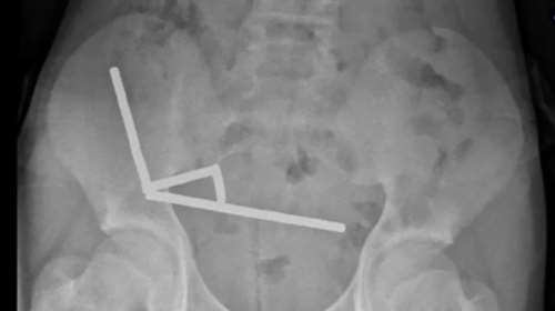 Νέα Ζηλανδία: 13χρονος κατάπιε σχεδόν 100 μαγνήτες και νέκρωσε ιστός στο έντερό του