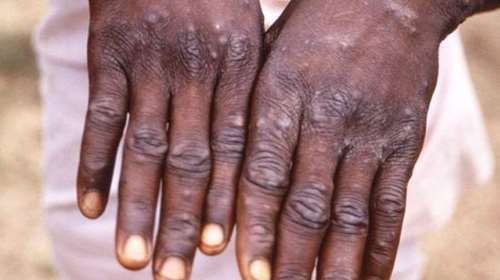 Τι γνωρίζουμε έως τώρα για την ευλογιά των πιθήκων: Πόσο διαρκεί η νόσος- Οι θεραπείες