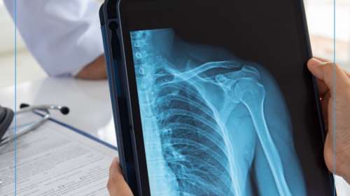 Ανάστροφη Αρθροπλαστική Ώμου: Μία ελάχιστα επεμβατική μέθοδος στο Ιατρικό Κέντρο Αθηνών