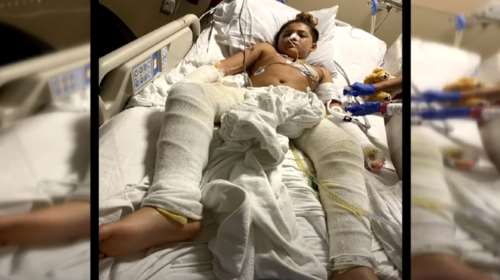 &quot;Fire challenge&quot;: 50 χειρουργεία έκανε 11χρονος που κάηκε προσπαθώντας να κάνει ότι είδε στο TikTok [Βίντεο]