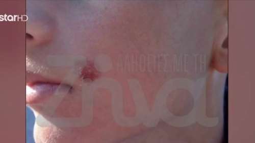 Άγριο bullying στην Πέλλα - Μαθητές έγιναν ο φόβος και ο τρόμος  σχολείου: Εσβησαν τσιγάρο στο μάγουλο συμμαθητή τους