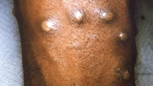 Ευλογιά των πιθήκων - Τζανάκης: Προφύλαξη με ατομική υγιεινή και καλό ψήσιμο στο κρέας