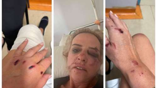 Καλαμάτα: Νέα επίθεση αδέσποτων σκύλων - Τραυματίστηκε σοβαρά γυναίκα με μηχανάκι [βίντεο - εικόνες]