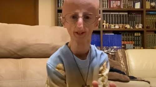 Πέθανε  ο Σάμι Μπάσο, ο άνδρας που έζησε περισσότερο από κάθε άλλο ασθενή με το σύνδρομο της προγηρίας