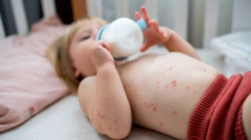 Κοκκύτης: Για ποιο λόγο υπάρχει επιδημική έξαρση στην Ελλάδα; Τι απαντά η Ελληνική Εταιρεία Λοιμώξεων