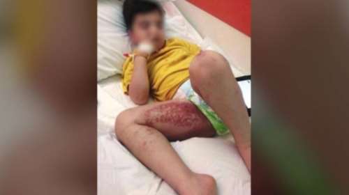 Ναύπλιο: Θαλάσσιες ανεμώνες &quot;επιτέθηκαν&quot; σε παιδιά - Τι πρέπει να κάνουμε αν μας τσιμπήσουν [βίντεο]