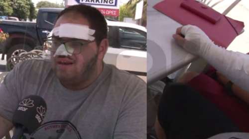 Αδιανόητο περιστατικό στην Κρήτη: Ανασφάλιστος μάγειρας έπαθε εγκαύματα β΄ βαθμού και τον έβαλαν σε δωμάτιο με κρέατα