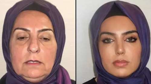 H ολική μεταμόρφωση της 68χρονης Ντιλέκ: &quot;Πριν και μετά&quot; - H πλαστική επέμβαση που συγκλόνισε το TikTok