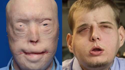 Αυτή είναι η πιο εκτεταμένη μεταμόσχευση προσώπου που έγινε ποτέ