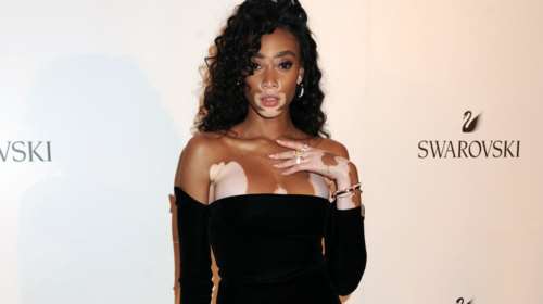 Πώς ένα μοντέλο με λεύκη έσβησε τις «κανονικές» συναδέλφους της