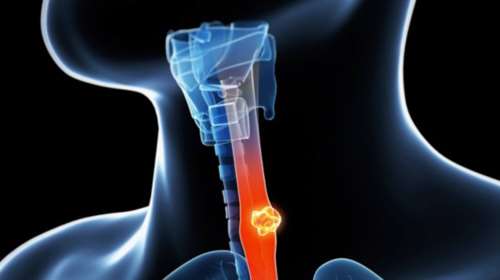 Τεστ &quot;βλέπει&quot; μορφή καρκίνου 10 χρόνια πριν εκδηλωθεί