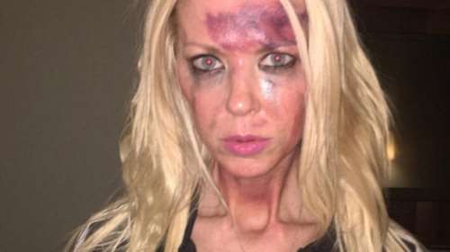 Ηθοποιός κακοποιημένη και μελανιασμένη στο instagram - Τι συνέβη;