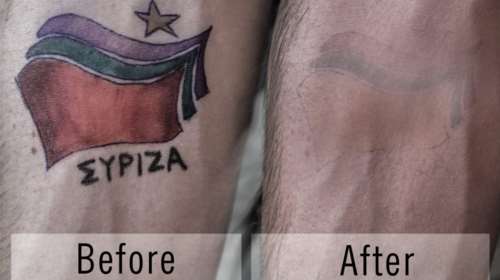 Είχε «χτυπήσει» τατουάζ με το λογότυπο του ΣΥΡΙΖΑ και το αφαίρεσε