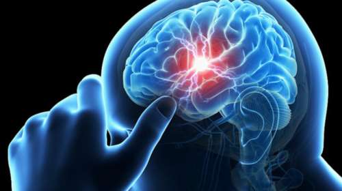 Διπλασιάστηκε ο κίνδυνος εγκεφαλικού στις ηλικίες κάτω των 45