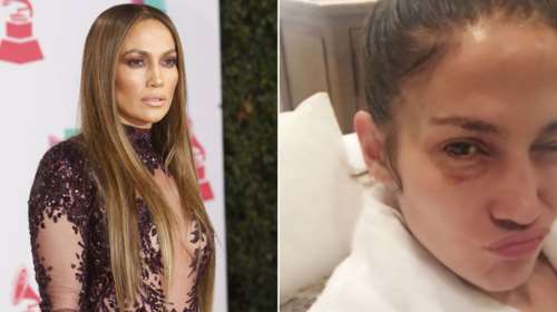 Μελανιασμένη στο instagram η Τζένιφερ Λόπεζ. Τι συνέβη