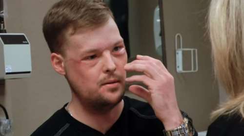 Μινεσότα: Εντυπωσιακή μεταμόσχευση προσώπου σε νεαρό άνδρα