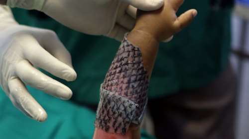 Με δέρμα ψαριού θεραπεύουν βαθιά εγκαύματα στη Βραζιλία