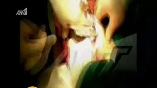 Σύνδρομο «Ραπουνζέλ» στο Παίδων Πεντέλης με μια 8χρονη [video]