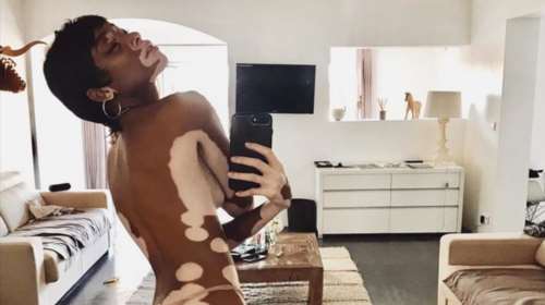 Είμαι όμορφη γιατί το ξέρω: Μοντέλο με λεύκη δίνει μάθημα αυτοπεποίθησης