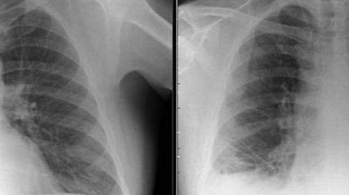 Οι γιατροί νόμιζαν ότι είχε καρκίνο, αλλά ο όγκος ήταν ένα Playmobil !