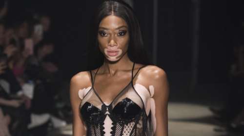 Το μοντέλο με το κορμί ζέβρας δείχνει τις υπέροχες ατέλειές της