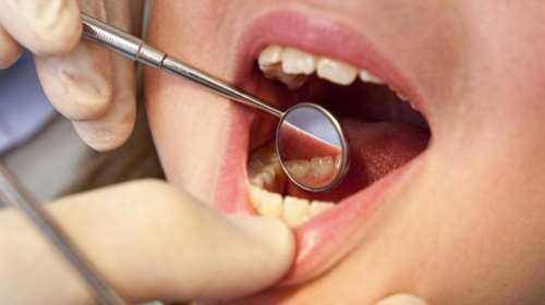 Η στοματική υγεία των Ελλήνων: Υπερβολή με τη λεύκανση, αμέλεια στην υγεία