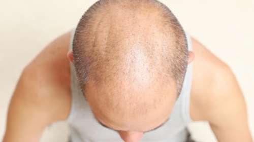 Βρέθηκε μέσω ...οστεοπόρωσης το φάρμακο για τη φαλάκρα;