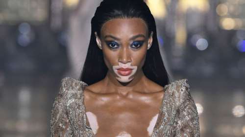 Γουίνι Χάρλοου: Μοντέλο με λεύκη για 1η φορά στο σόου της Victoria&#39;s Secret