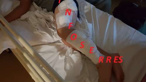 Σοκάρουν οι εικόνες από την επίθεση σκύλων σε 9χρονο