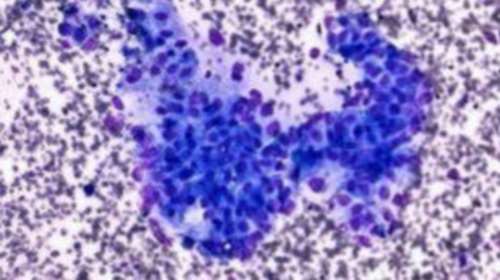 Μια τυχαία ανακάλυψη οδηγεί σε θεραπεία όλων των καρκίνων;