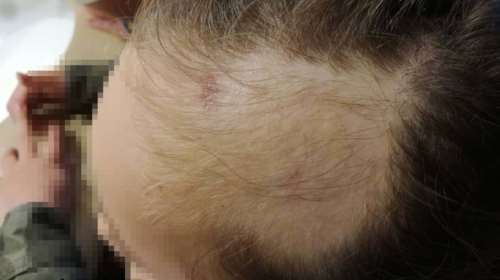 Σοκαριστικό ατύχημα σε Νηπιαγωγείο: Πεντάχρονη σφήνωσε σε κούνια - φωτό