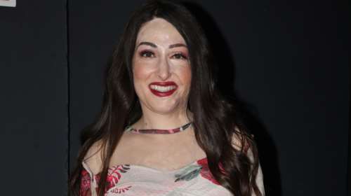 Συγκλονίζει η Ιωάννα Παλιοσπύρου: &quot;Δεν έχω αυτί, το πτερύγιο έχει απανθρακωθεί&quot;