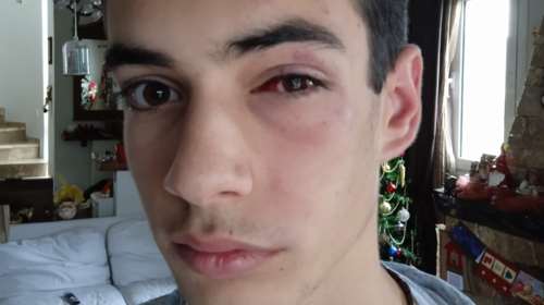 Αγριος ξυλοδαρμός 15χρονου στη Χαλκιδική – Η ανάρτηση της μητέρας του [εικόνα]