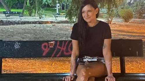 Αθηναΐδα Νέγκα: Το αισχρό σχόλιο για τη λεύκη στα πόδια και η απάντησή της