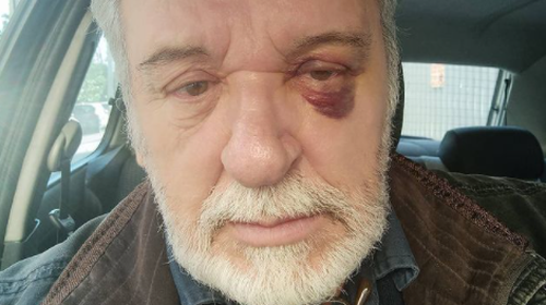 Με μελανιασμένο μάτι ο Τάσος Χαλκιάς: &quot;Όσοι δεν σε ξέρουν σε γλωσσοτρώνε&quot; [εικόνα]